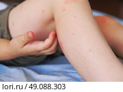 Child scratch body has sensitive itchy skin. Bodily rash. Kid allergy closeup. Little baby scratches eruption. Irritation, hive. Pruritus. Mosquito insect bite. Red from sunburn, Seborrheic Dermatitis. Стоковое фото, фотограф Марина Демидюк / Фотобанк Лори