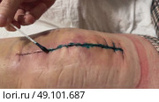 After the surgery, the stitched areas on the body are covered with Betadine antiseptic. Medical surgical care. Close-up. Стоковое видео, видеограф Ирина Старикова / Фотобанк Лори