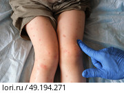 Doctor examining child with bodily red rash. Kid allergy closeup. Little baby scratches an eruption. Nurse applies special cream to atopic skin. Dermatitis, irritation, hive. Pruritus. Mosquito bites. Стоковое фото, фотограф Марина Демидюк / Фотобанк Лори