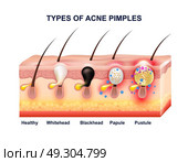 Skin Acne Anatomy Composition. Colored skin acne anatomy composition with types of acne pimples before and after vector illustration. Стоковая иллюстрация, агентство Ingram Publishing / Фотобанк Лори