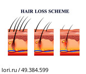 Stages of hair loss on human skin, scheme with anatomy structure including follicles, veins, nerves, vector illustration . Hair Loss Scheme. Стоковая иллюстрация, агентство Ingram Publishing / Фотобанк Лори