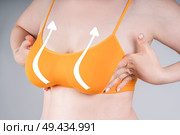 Saggy breast augmentation, female body with surgical lines, plastic surgery, lifting and aesthetic medicine concept. Стоковое фото, фотограф Станислав Тарко / Фотобанк Лори