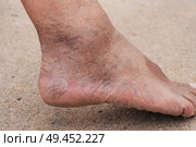 Bare male feet with a large callus on the heel and venous dilatation of veins. Стоковое фото, фотограф Корчагина Анастасия / Фотобанк Лори
