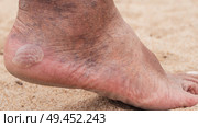 Bare male feet with a large callus on the heel and venous dilatation of veins. Стоковое фото, фотограф Корчагина Анастасия / Фотобанк Лори