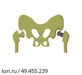 Pelvis and metal prosthesis implanted, in order to replace absent part of bone human body, allowing person move freely painlessly vector illustration. Pelvis and Metal Prosthesis Vector Illustration. Стоковая иллюстрация, агентство Ingram Publishing / Фотобанк Лори
