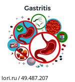 Gastritis disease symptoms causes medicine flat circular composition of healthy and affected stomach bacteria food vector illustration. Стоковая иллюстрация, агентство Ingram Publishing / Фотобанк Лори