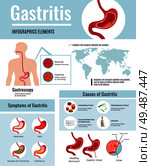 Gastritis symptoms stomach ulcer causes information on unhealthy food habits world population affected infographic poster vector illustration. Стоковая иллюстрация, агентство Ingram Publishing / Фотобанк Лори