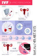 Colored flat in vitro fertilization IVF  infographics with steps for pregnancy progress vector illustration. Стоковая иллюстрация, агентство Ingram Publishing / Фотобанк Лори