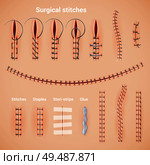 Surgical suture stitches realistic set of stitching methods and shapes with staples glue and text captions vector illustration. Стоковая иллюстрация, агентство Ingram Publishing / Фотобанк Лори