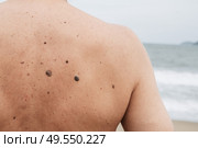 The back of an elderly man with freckles, aging spots, black, brown warts and wrinkles against the background of the sea. Стоковое фото, фотограф Корчагина Анастасия / Фотобанк Лори