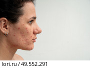 Close-up skin texture with red pimples, irritation and clogged pores, which indicates dermatological problems with skin care. Hormonal acne and spots on the face. Стоковое фото, фотограф Корчагина Анастасия / Фотобанк Лори
