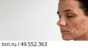 Close-up portrait of a young Caucasian woman with skin problems - pimples, acne, enlarged pores. A place for your text. Стоковое фото, фотограф Корчагина Анастасия / Фотобанк Лори