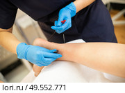 Electro-acupuncture dry with needle connecting machine. Electro stimulation in physical therapy.. Electro acupuncture dry with needle connecting machine. Стоковое фото, агентство Ingram Publishing / Фотобанк Лори
