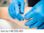 Close-up of a needle and hands of physiotherapist doing a dry needling in a physiotherapy center.. Hands of physiotherapist doing a dry needling. Стоковое фото, агентство Ingram Publishing / Фотобанк Лори