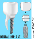 Realistic white dental implant and human tooth. Dentistry, medicine and oral cavity health concept. Denture construction, dental prosthesis structure. Information banner about teeth and implants. Realistic white dental implant and human tooth. Dentistry, medicine and oral cavity health. Стоковая иллюстрация, агентство Ingram Publishing / Фотобанк Лори