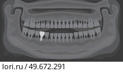 Black and white x-ray of human jaw with normal teeth and dental implant. Tooth after dental procedure. Surgical implant in oral cavity. Treatment, dentistry, health care. Radiograph with prosthesis. X-ray of human jaw with normal teeth and dental implant. Radiograph with prosthesis in gum. Стоковая иллюстрация, агентство Ingram Publishing / Фотобанк Лори