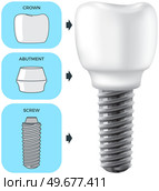 Realistic white dental implant and human tooth. Dentistry, medicine and oral cavity health concept. Denture construction, dental prosthesis structure. Information banner about teeth and implants. Realistic white dental implant and human tooth. Dentistry, medicine and oral cavity health. Стоковая иллюстрация, агентство Ingram Publishing / Фотобанк Лори