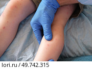 Doctor examining child with bodily red rash. Kid allergy closeup. Little baby scratches an eruption. Nurse applies special cream to atopic skin. Dermatitis, irritation, hive. Pruritus. Mosquito bites. Стоковое фото, фотограф Марина Демидюк / Фотобанк Лори