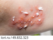 Woman with shingles on the skin she feels very painful. Стоковое фото, фотограф Anastasia Kayander / Фотобанк Лори