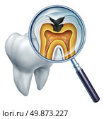 Tooth cavity close up and cavities symbol showing a magnifying glass with a cross section of a tooth anatomy in decay due to bacteria and acids in oral health care showing rotting and disease due to lack of brushing. Стоковое фото, агентство Ingram Publishing / Фотобанк Лори