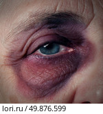 Senior abuse or elder mistreatment as an old person with a black eye bruised and injured from domestic violence on older aging adults fromn a retirement home or caretaker who has broken the trust as a legal health care concept. Стоковое фото, агентство Ingram Publishing / Фотобанк Лори
