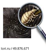 Lice problem as a medical concept of a magnifying glass close up of a human head with an infestation of parasitic nits or eggs hatching from a louse insect as a symbol of diagnosis prevention and treatment for children and adults. Стоковое фото, агентство Ingram Publishing / Фотобанк Лори