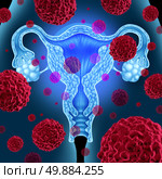 Uterus or uterine cancer medical concept as cancerous cells spreading in a female body attacking the reproductive system anatomy including ovaries and fallopian tubes as a health care symbol of cervical tumor growth treatment and risks. Стоковое фото, агентство Ingram Publishing / Фотобанк Лори