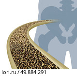 Osteoporosis medical illustration concept as a close up diagram of the inside of a human bone from a skeletal hip joint as a normal healthy condition gradually degrades to abnormal unhealthy bone mass on a white background. Стоковое фото, агентство Ingram Publishing / Фотобанк Лори