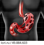 Stomach problem medical health care concept as the human digestion organ with holes as a metaphor for abdominal peptic ulcer pain or gastric acid stress. Стоковое фото, агентство Ingram Publishing / Фотобанк Лори