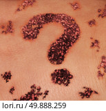 Suspicious skin mole as a medical dermatology concept for screening moles as a dark red growth on the human epidermis shaped as a question mark as a symbiol for uncertain diagnosis iof a benign or malignant melanoma cancer. Стоковое фото, агентство Ingram Publishing / Фотобанк Лори