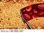 Removing cholesterol and cleaning arteries medical concept as a wiper removing plaque buildup in a clogged artery as a symbol of atherosclerosis disease hospital treatment by opening clogged veins as a 3D illustration. Стоковое фото, агентство Ingram Publishing / Фотобанк Лори