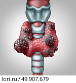Thyroid gland cancer concept as a human organ with a malignant tumor growth as a symbol for endocrinology system disease with 3D illustration elements. Стоковое фото, агентство Ingram Publishing / Фотобанк Лори
