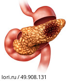 Pancreatic cancer concept and Pancreas malignant tumor symbol as a digestive gland body part with stomach cross section with a malignant tumor growth with 3D illustration elements. Стоковое фото, агентство Ingram Publishing / Фотобанк Лори
