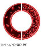 Anemia and anaemia medical diagram concept as normal and abnormal blood cell count and human circulation in an artery or vein as a 3D illustration isolated on a white background. Стоковое фото, агентство Ingram Publishing / Фотобанк Лори