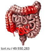 Crohna??s disease or crohn illness medical concept as human intestines with inflammation symptoms causing obstruction as a 3D illustration. Стоковое фото, агентство Ingram Publishing / Фотобанк Лори