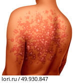 Psoriasis illness and autoimmune disease as dry red skin patches on a patient as a symbol for dermatology illness in a 3D illustration style. Стоковое фото, агентство Ingram Publishing / Фотобанк Лори