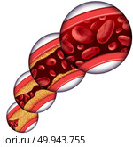 Coronary artery cholesterol therapy medical concept as a vein with gradual plaque removal from clogged arteries and atherosclerosis with with a 3D human anatomy diagram of the reduction of cholesterol buildup. Стоковое фото, агентство Ingram Publishing / Фотобанк Лори