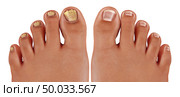 Onychomycosis and fungal nail infection or tinea unguium as an infected foot toenail or toe nail with damaged unhealthy and healthy human anatomy in a 3D illustration style. Стоковое фото, агентство Ingram Publishing / Фотобанк Лори