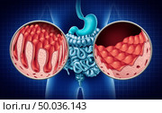 Celiac or coeliac,disease of the intestine anatomy medical concept with normal villi and damaged small bowel lining as an autoimmune disorder of the digestion system with colon and stomach as a 3D illustration. Стоковое фото, агентство Ingram Publishing / Фотобанк Лори