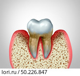 Periodontitis gum disease and poor oral tooth hygiene health problem as a bacteria infection diagram concept with inflammation as a 3D illustration. Стоковое фото, агентство Ingram Publishing / Фотобанк Лори