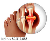 Foot gout and painful feet arthritis disease as toes close up with a human toe as a hyperuricemia symbol of treating and diagnosing chronic pain isolated on a white background as a 3D illustration style. Стоковое фото, агентство Ingram Publishing / Фотобанк Лори