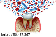 Tooth decay and blood bacteria and disease as an unhealthy molar with periodontitis due to poor oral hygiene health problem as a bacterial infection with inflammation as a 3D illustration on a white background. Стоковое фото, агентство Ingram Publishing / Фотобанк Лори