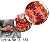 Crohn’s disease pain and Crohn syndrome illness or crohns disorder as a medical concept with a close up of a human intestine with inflammation symptoms causing obstruction with 3D illustration elements. Стоковое фото, агентство Ingram Publishing / Фотобанк Лори