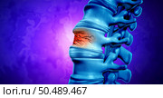 Traumatic Spine Fracture and vertebral injury medical concept as a human anatomy spinal column with a broken burst vertebra due to compression or other osteoporosis back disease as a 3D illustration. Стоковое фото, агентство Ingram Publishing / Фотобанк Лори