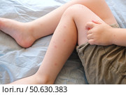 Child scratch body has sensitive itchy skin. Bodily rash. Kid allergy closeup. Little baby scratches eruption. Irritation, hive. Pruritus. Mosquito insect bite. Red from sunburn, Seborrheic Dermatitis. Стоковое фото, фотограф Марина Демидюк / Фотобанк Лори