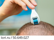 Man with early-stage baldness using a microneedling roller with sharp needles for scalp massage and hair regrowth treatment. Стоковое фото, фотограф Татьяна Степанищева / Фотобанк Лори