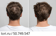 Hair Loss Before After Frontal and Crown Restoration. Стоковое AI-изображение, AI-художник Katsiaryna Repich / Фотобанк Лори