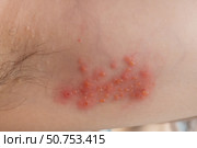 Woman with shingles on the skin she feels very painful. Стоковое фото, фотограф Anastasia Kayander / Фотобанк Лори