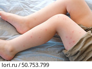 Child scratch body has sensitive itchy skin. Bodily rash. Kid allergy closeup. Little baby scratches eruption. Irritation, hive. Pruritus. Mosquito insect bite. Red from sunburn, Seborrheic Dermatitis. Стоковое фото, фотограф Марина Демидюк / Фотобанк Лори