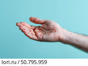 Human Hands with Painful Rash, Red Spots Blisters on the Skin. Health Problem. Monkeypox Disease Symptoms. Male Patient Arms with Monkey Pox. Close Up. Dengue Fever Infection, MPOX. Herpes, Pox Virus. Стоковое AI-изображение, AI-художник Марина Демидюк / Фотобанк Лори